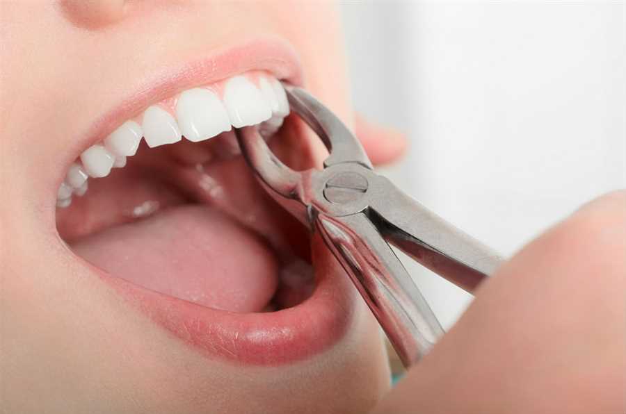 Singapore Dental Wisdom Tooth Extraction